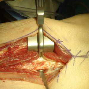 BG_NB_2_Fibula_Raspatorium