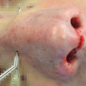 BG_NB_1_Haack_Adapter