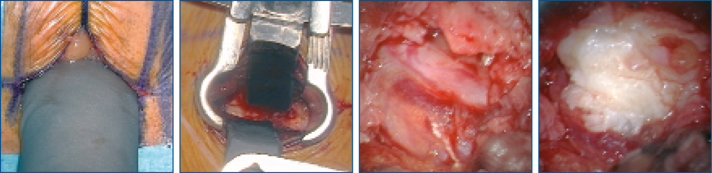 Extraforaminaler Zugang mit Piccolino - intraoperative Aufnahmen