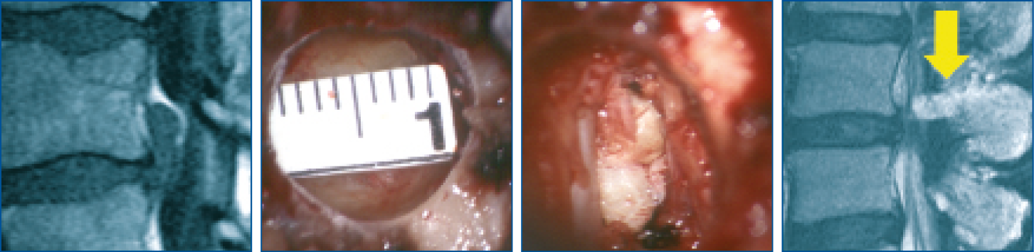 Translaminärer Zugang mit Piccolino - intraoperative Aufnahmen