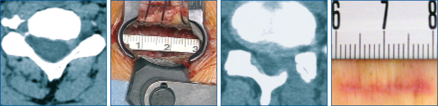 Dorsolaterale Foraminotomie mit Piccolino - intraoperative Aufnahmen