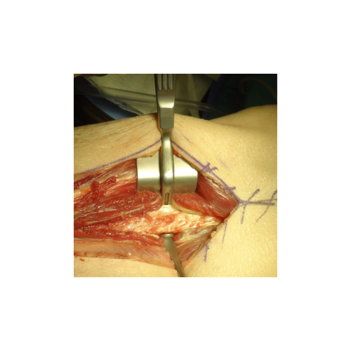 Fibula_500x500_nb1