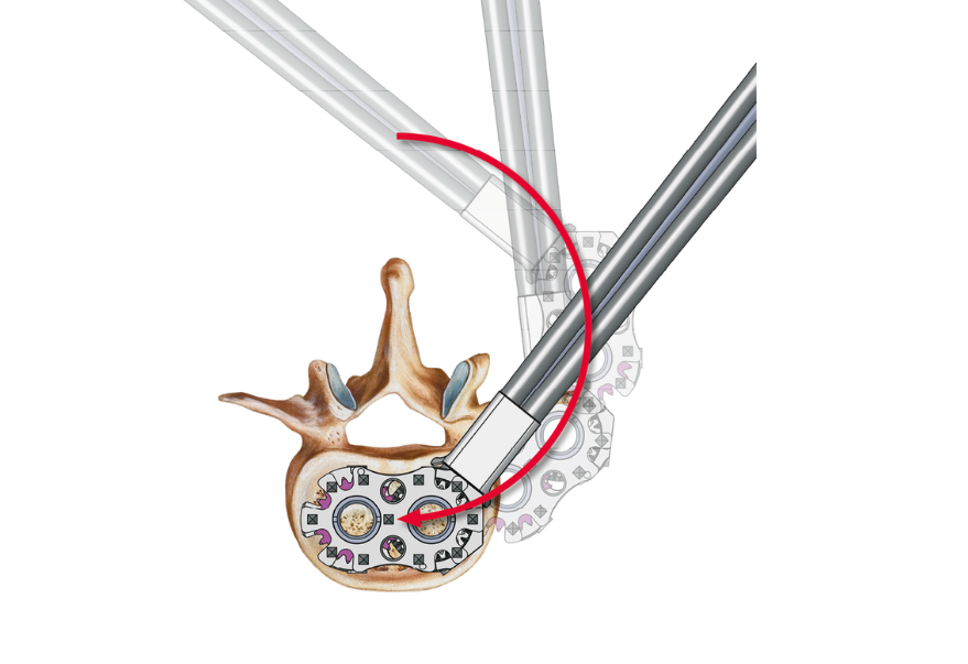 Dorsolateraler Zugang