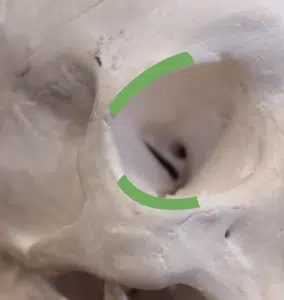 Knochenschädel_Position der Augenplatte. Auf dem Bild ist der obere und untere Rand der Augenhöhle (Orbita) grün markiert. Der obere grüne Bereich entspricht dem Orbitalrand (Rand der Augenhöhle), der hauptsächlich vom Stirnbein (Os frontale) gebildet wird. Der untere grüne Bereich ist der untere Orbitalrand, der vor allem vom Jochbein (Os zygomaticum) gebildet wird.
