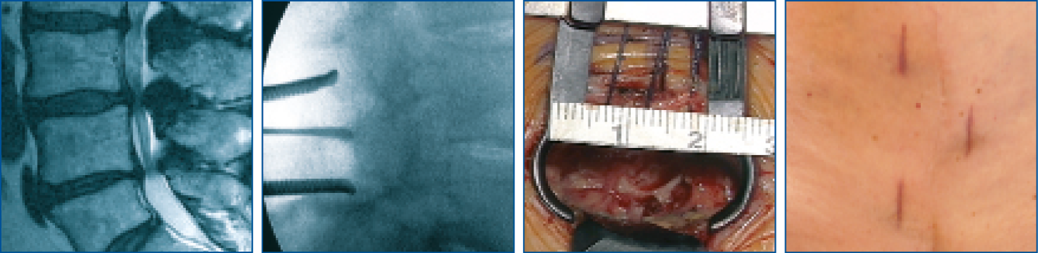 Interlaminärer Zugang mit Piccolino - intraoperative Aufnahmen